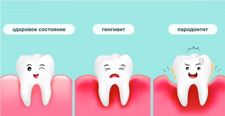 Заболевания дёсен при COVID-19