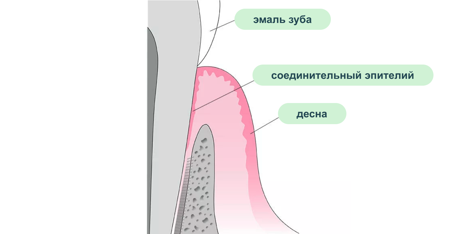 Катаральный гингивит