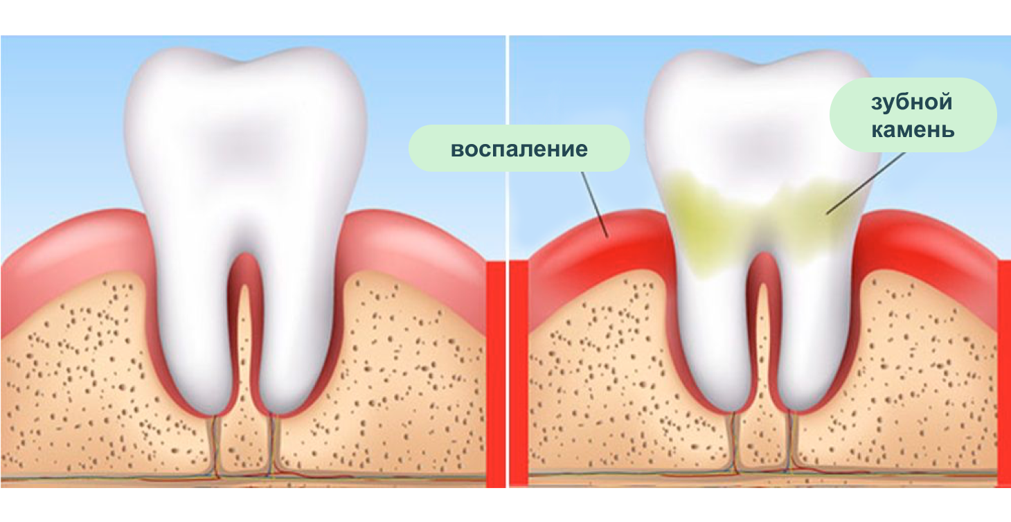 Причины катарального гингивита