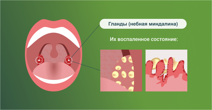 Как выглядят воспаленные гланды (при хроническом тонзиллите)