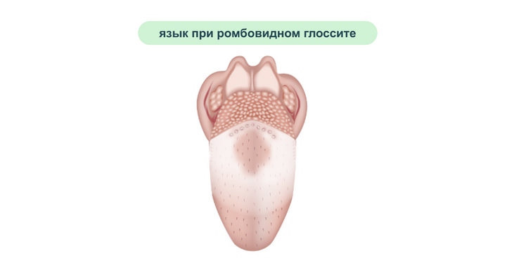 Язык при ромбовидном глоссите