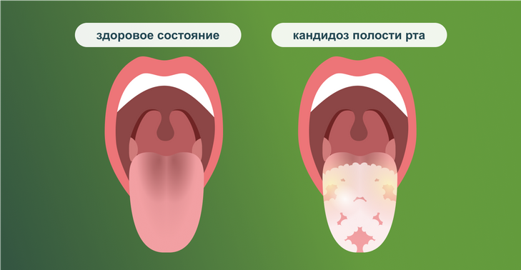 Кандидоз рта у детей