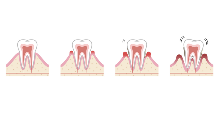Что такое пародонтоз?